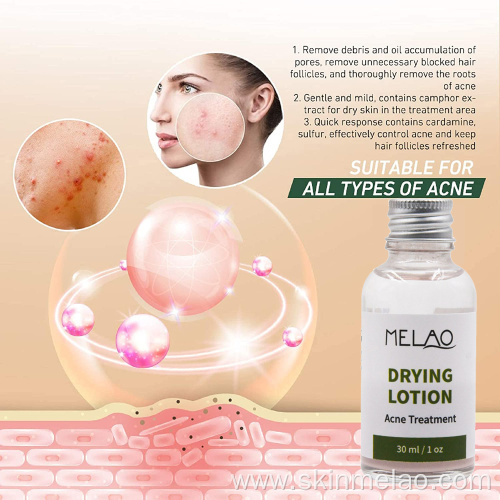 Drying Lotion Anti Acne Spot Treatment Serum